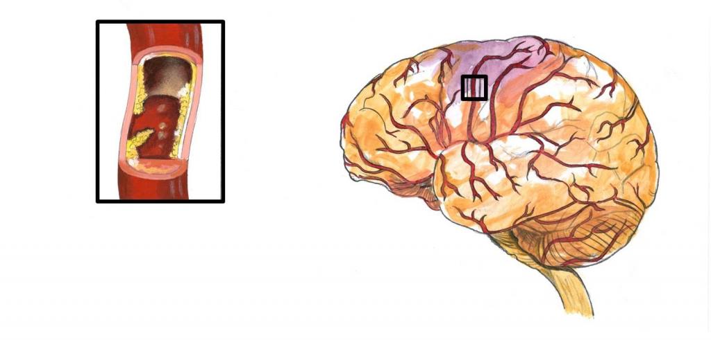 Диета При Церебральном Атеросклерозе Головного Мозга