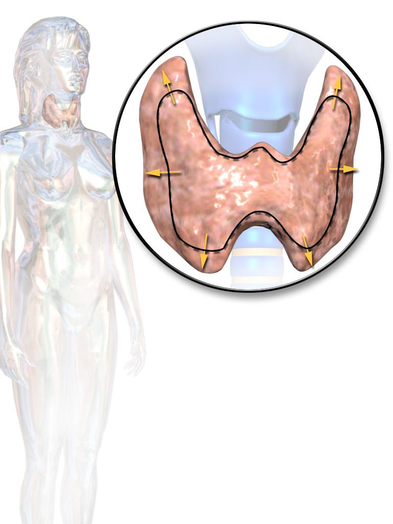 многоузловой зоб щитовидной железы 2 степени