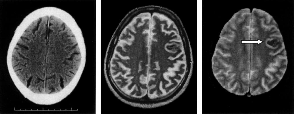 Компьютерная томография мозга