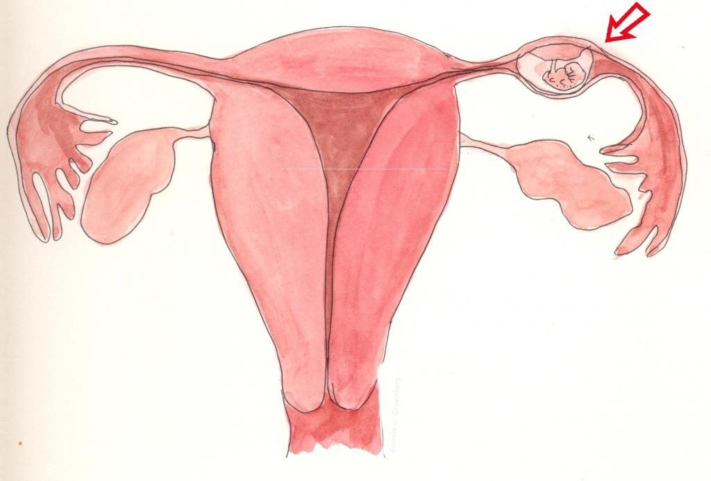 Как исключить внематочную беременность? Внематочная беременность: тест покажет или нет?