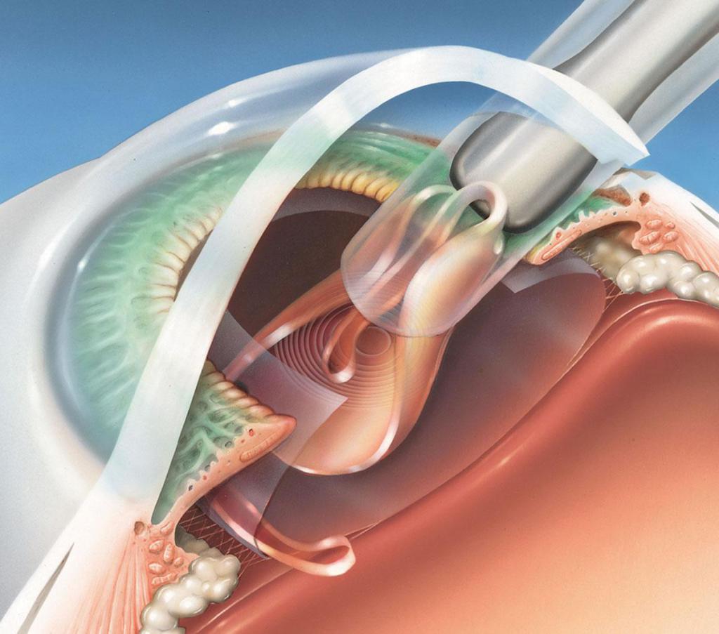 Схема проведения операции по удалению катаракты