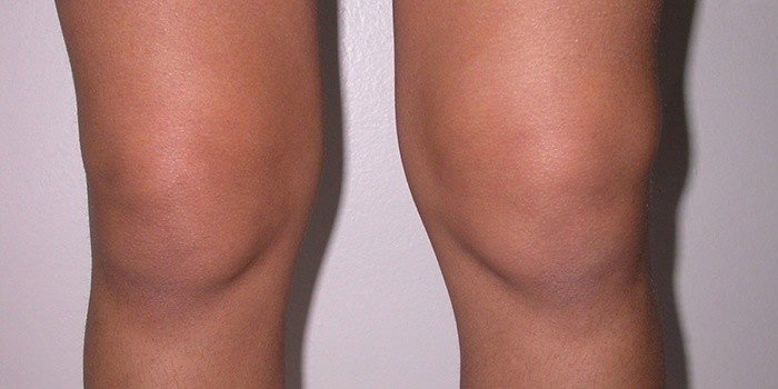 Симптомы бурсита коленного сустава