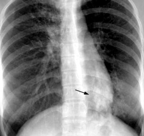 диссеминированный туберкулез легких в фазе распада 