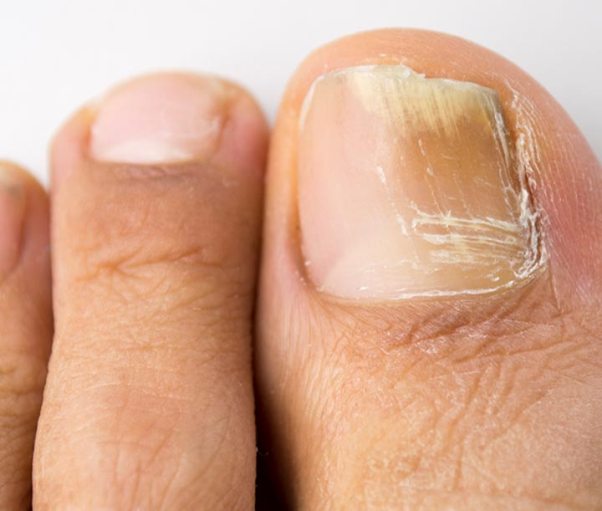 грибок большого пальца на ноге лечение
