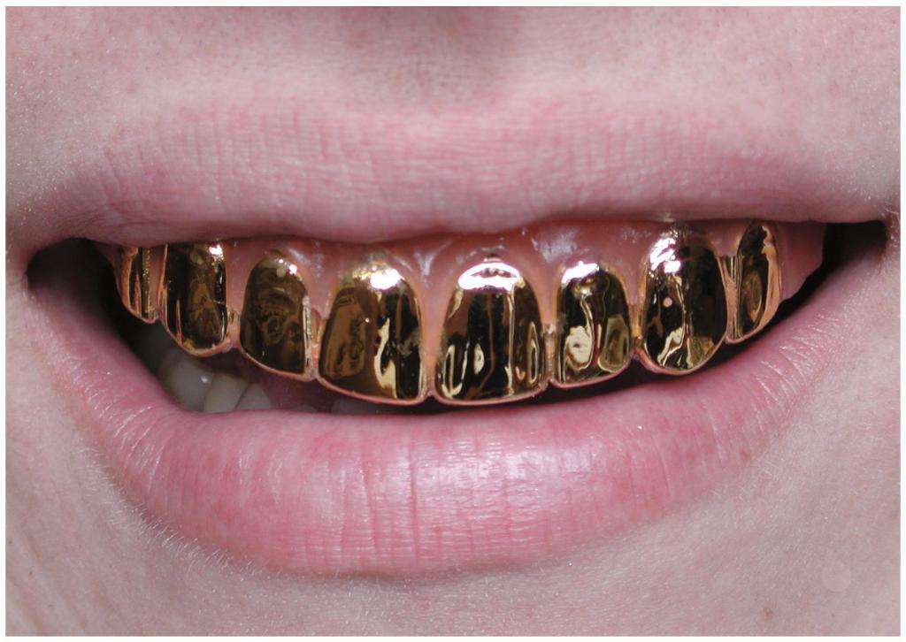 Металлические зубы