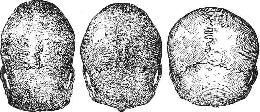 Долихоцефалический (а), мезоцефалический (б) и брахицефалический (в) череп (вид сверху)