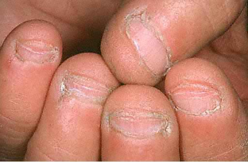 сухая кожа вокруг ногтей