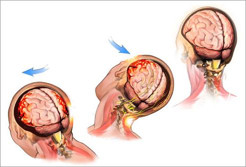 Как лечить сотрясение мозга