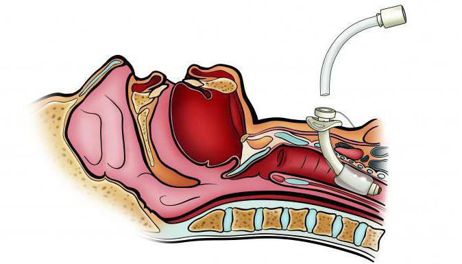 операция трахеотомия