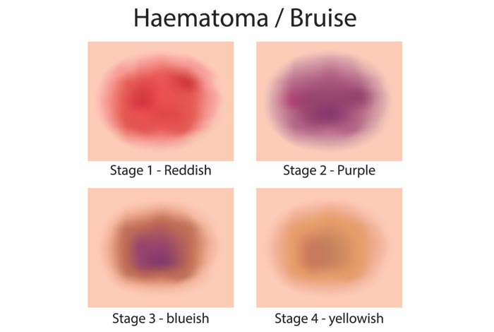 Стадии гематомы