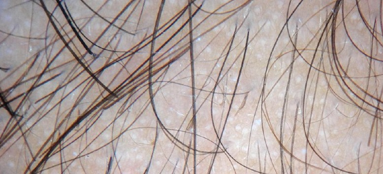 Диагностика выпадения волос особенности