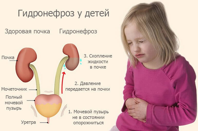 Гидронефроз у детишек