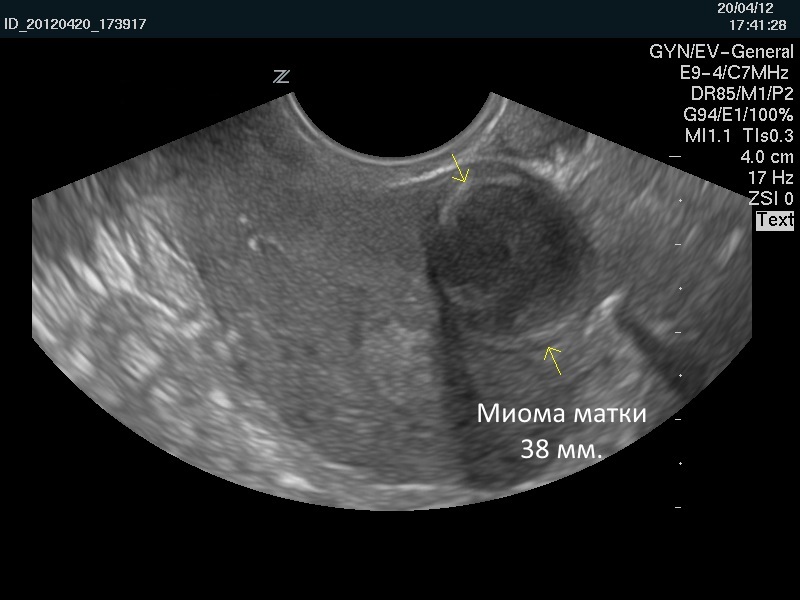 Миома матки на узи