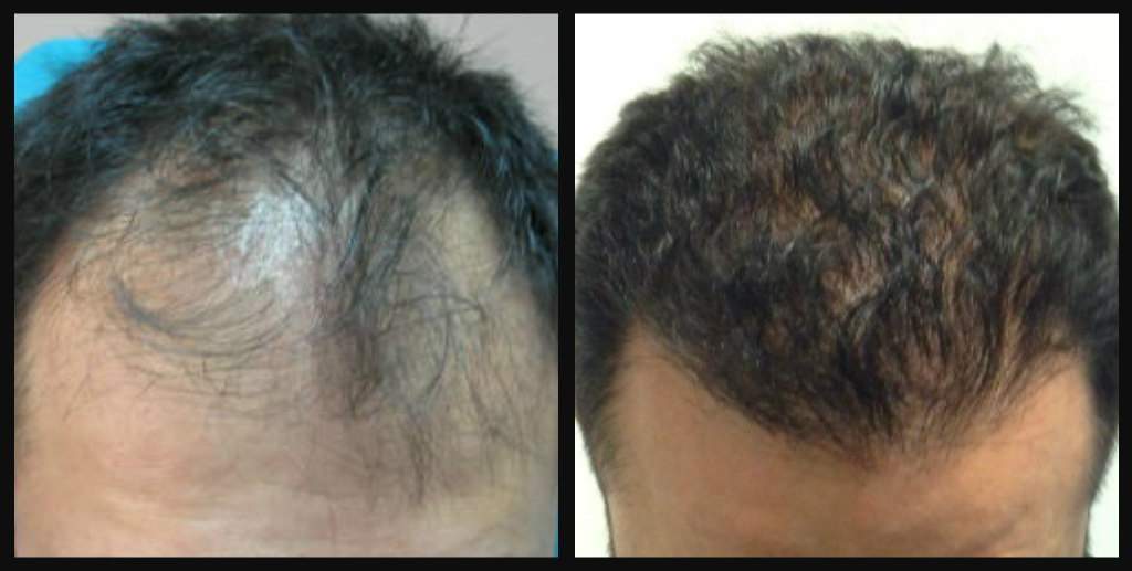 Пересадка волос в Турции: методика, цена, отзывы