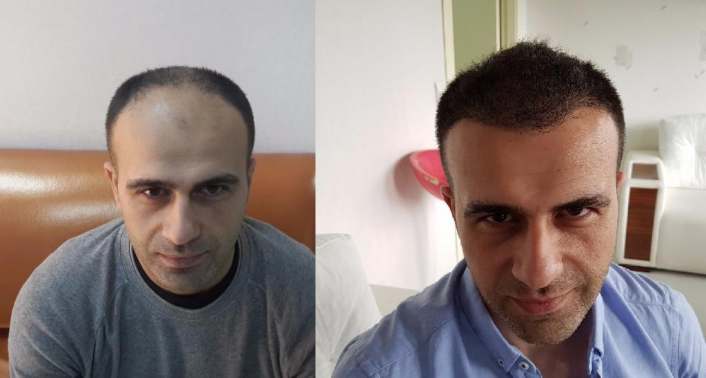 Пересадка волос в Турции: методика, цена, отзывы