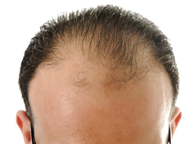 Средства от выпадения волос для мужчин: виды, рейтинг, составы, условия применения, фото до и после