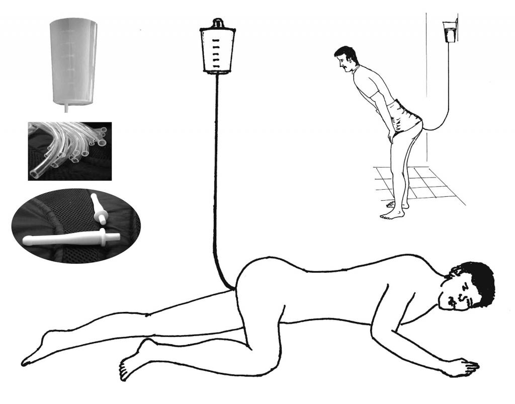 Правильная постановка клизмы