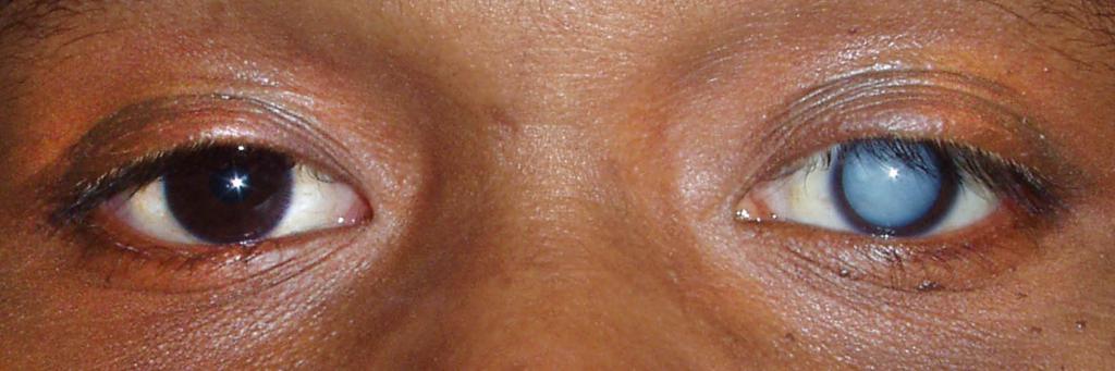 Появление «слепых пятен» при глаукоме