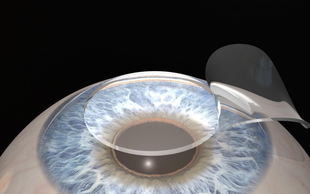 лазерная коррекция зрения восстановление после операции
