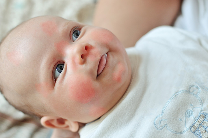 Симптомы аллергии у новорожденного