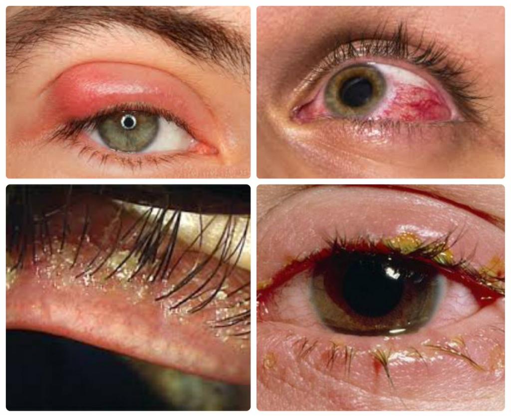 симптомы глазного демодекоза