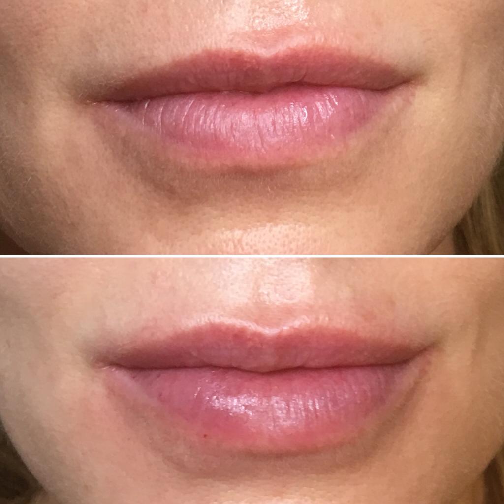 Больно ли увеличивать губы: описание процедуры, фото, отзывы