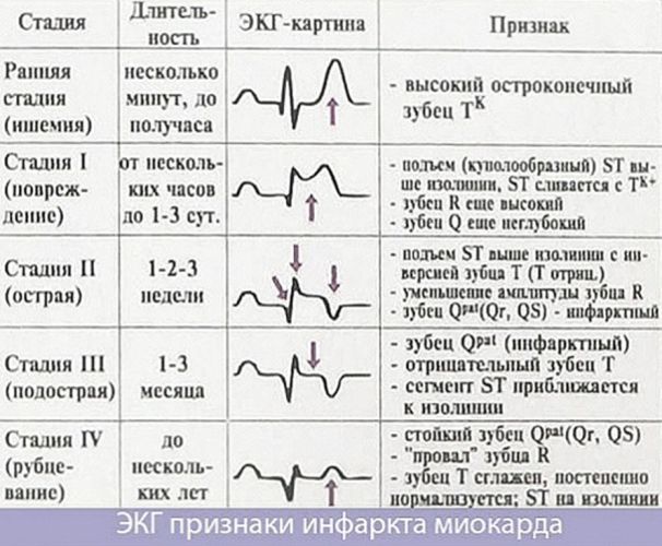 Шифровка Электрокардиограмма на российском языке
