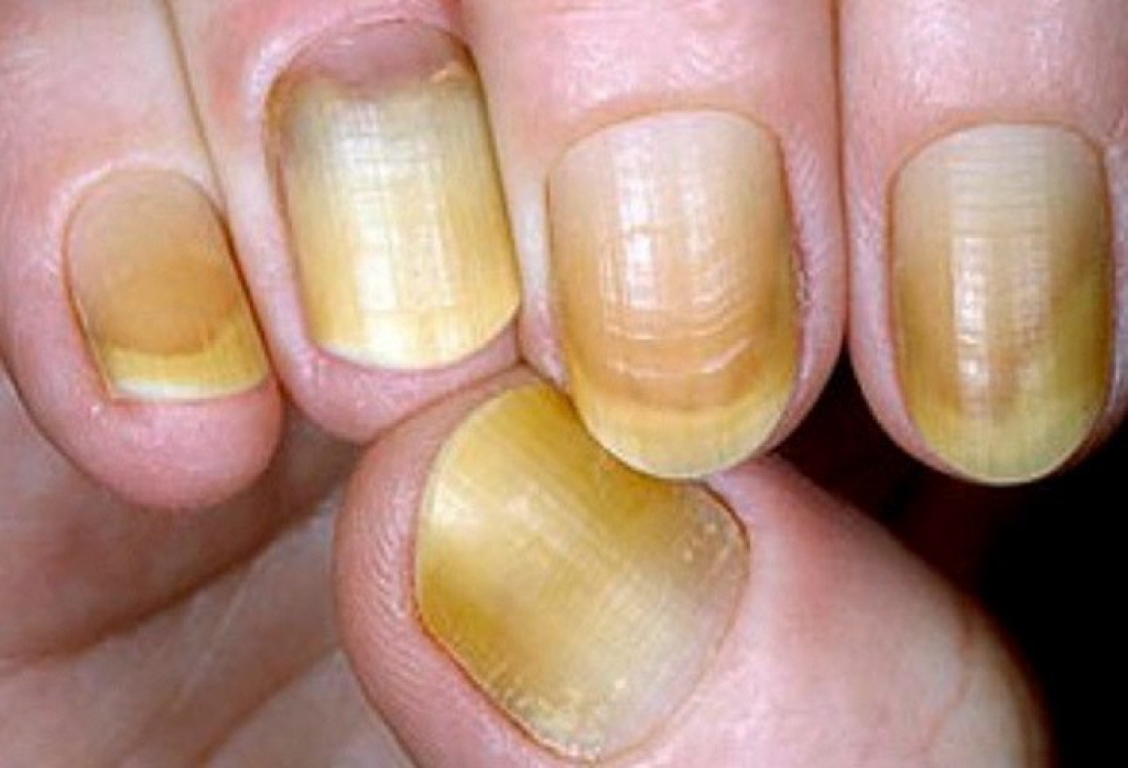 заболевание гриб ногтей