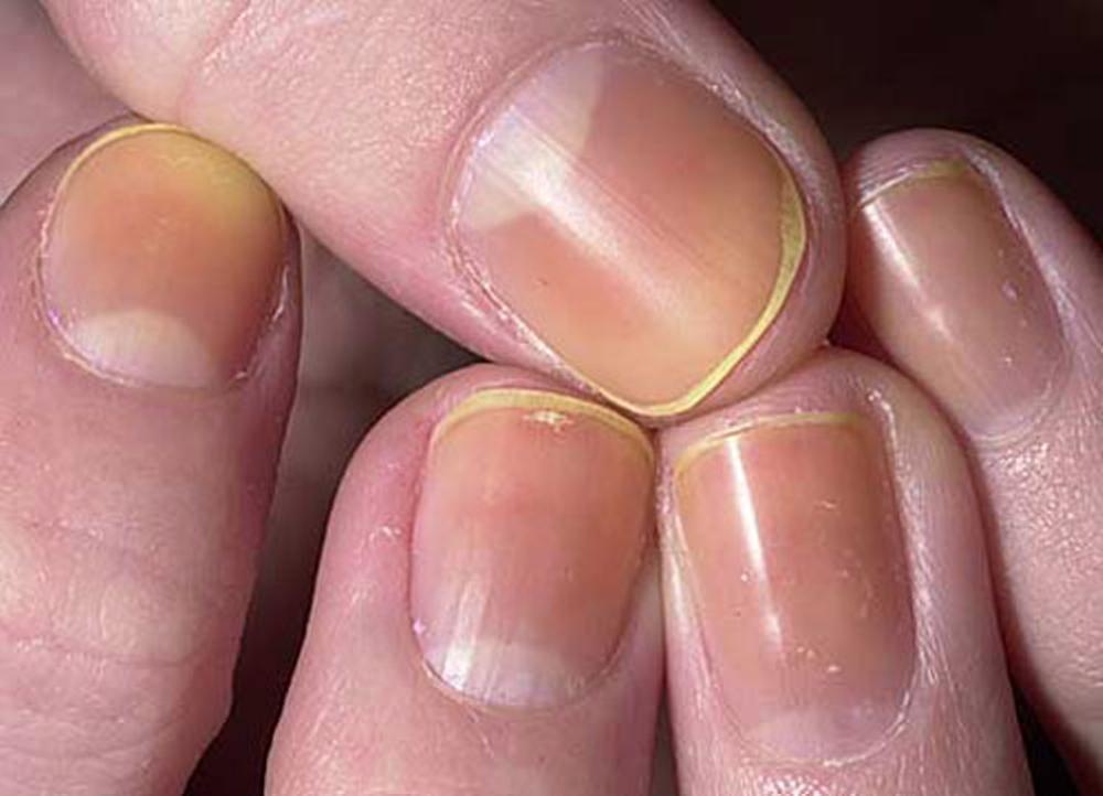 ногти заболевания лечения