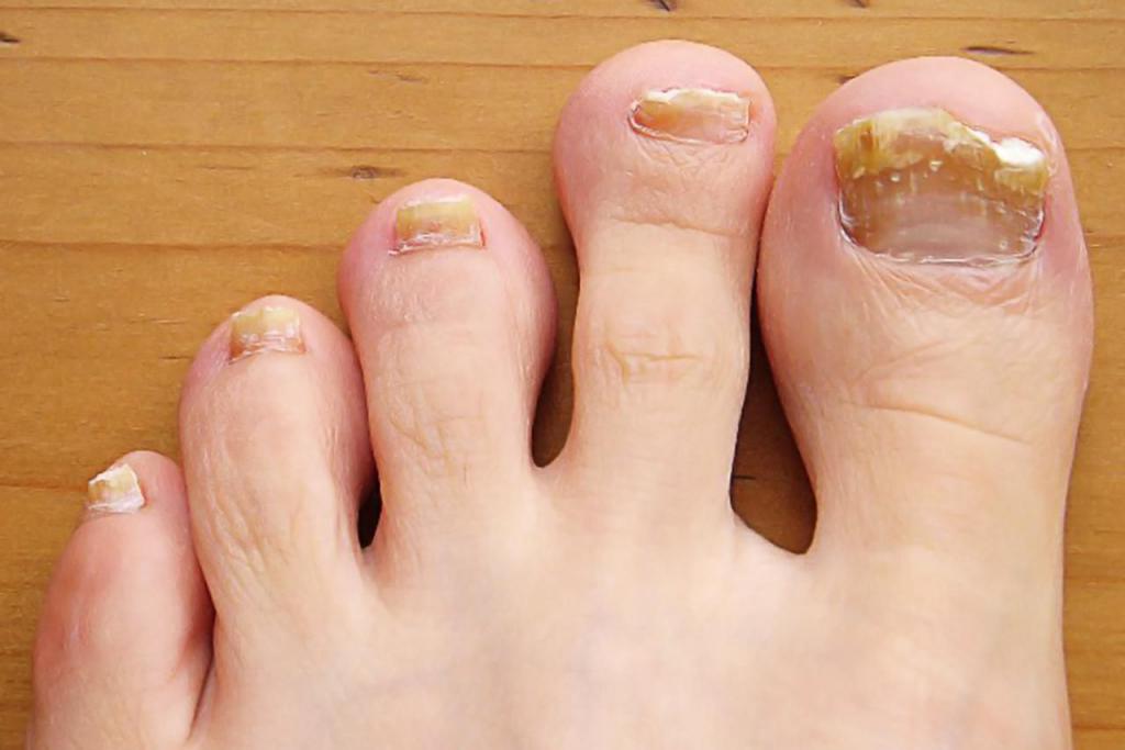 заболевания ногтей фото и описание