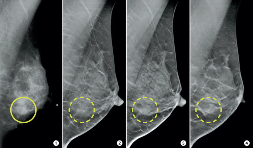 Снимок маммограммы