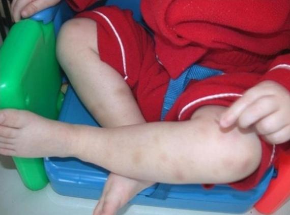 повышены тромбоциты у ребенка