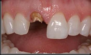 протезирование переднего зуба