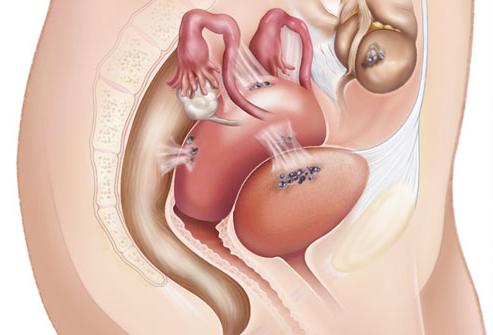 внутренний эндометриоз тела матки
