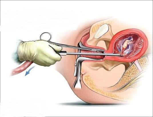 Как и где сделать аборт