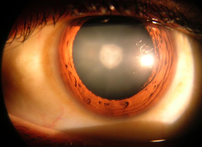 Что такое катаракта глаза?