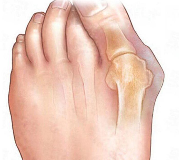 разделитель для пальцев ног силиконовый ортопедический 