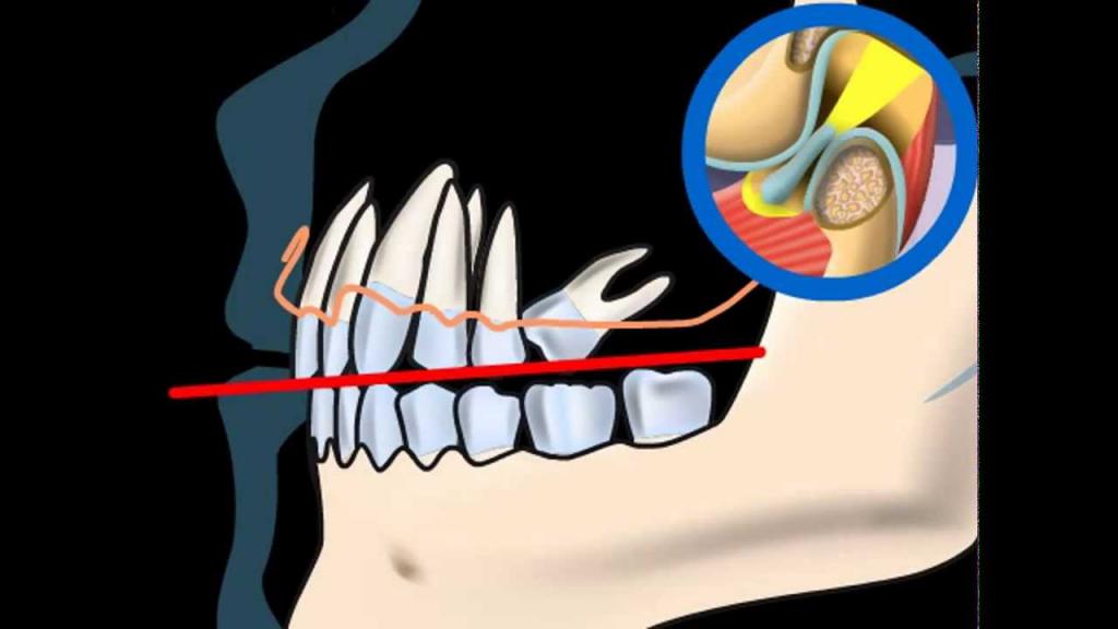мезиальная окклюзия зубных рядов