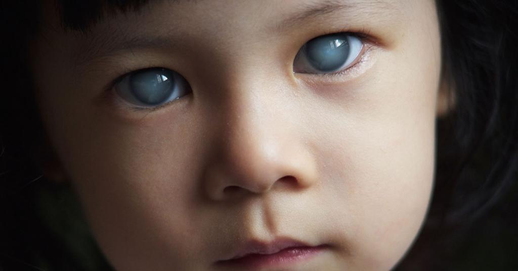 катаракта глаза у ребенка