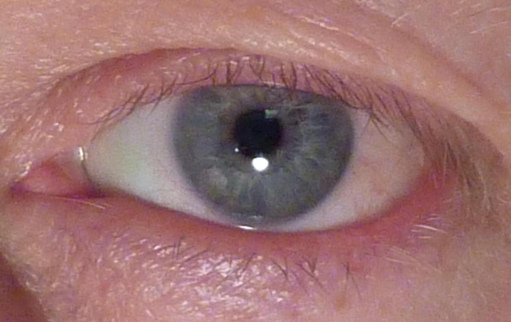 птеригиум глаза