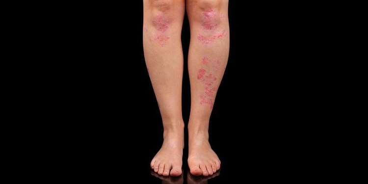 Сохнет кожа на ногах: причины и лечение. Крем для ухода за кожей ног