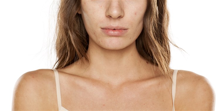 Уход за кожей после пилинга: особенности проведения процедуры, реакция кожи и ее восстановление