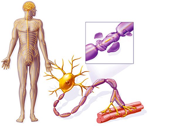 Нерв при рассеянном склерозе