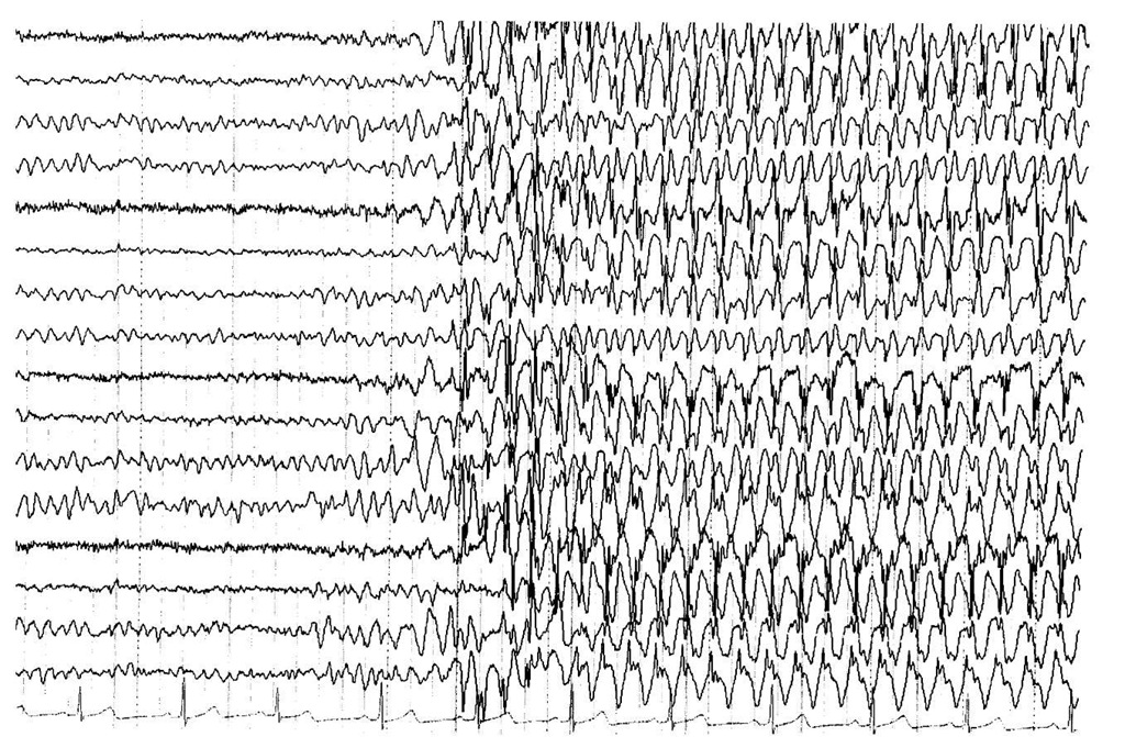 ЭЭГ при эпилепсии