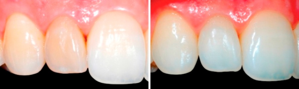 внутриканальное отбеливание зубов фото до и после