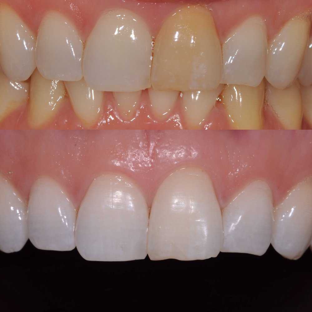 внутриканальное отбеливание зубов до и после