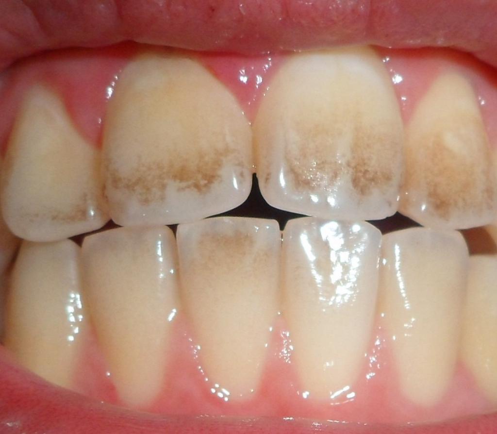 внутриканальное отбеливание зубов опалесценс методика