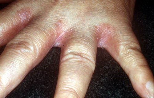 Кожа между пальцами рук шелушится: причины и методы лечения. Советы по уходу за кожей рук