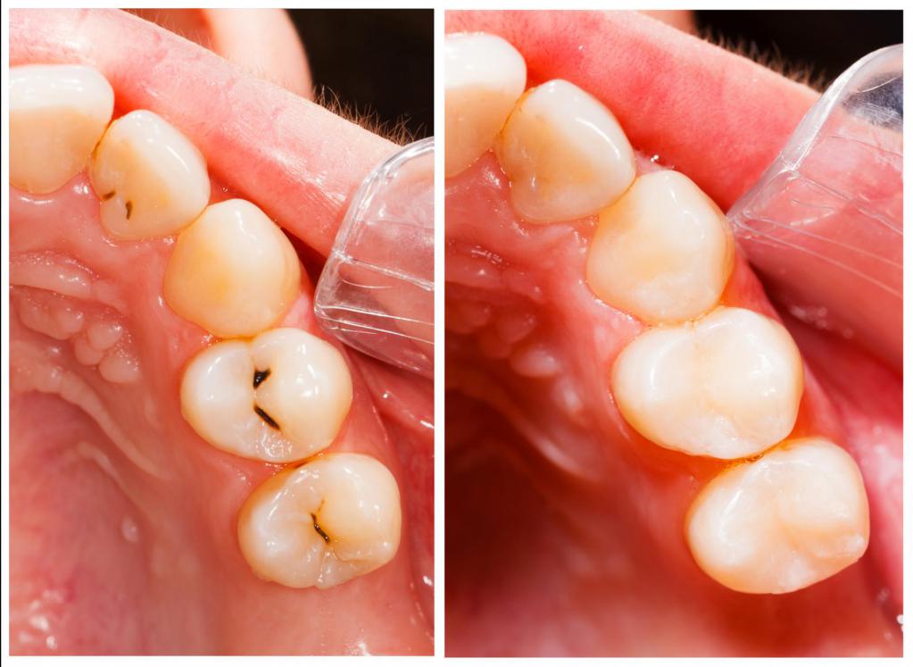 Кариес - основная болезнь зубов