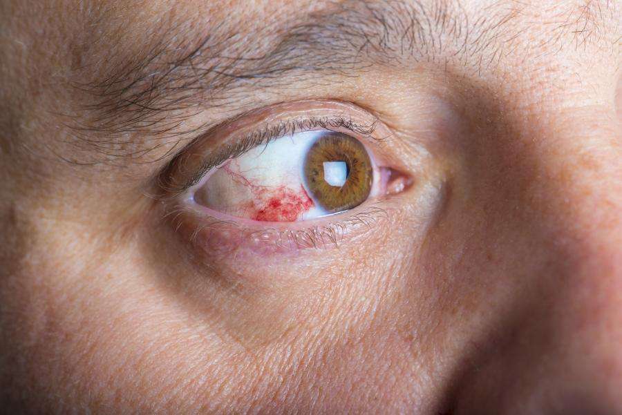 частичный гемофтальм глаза лечение